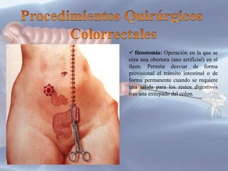  Colostomía: Creación de una
abertura artificial permanente (ano
artificial) abocando al exterior el colon,
que es sutura...