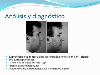 Análisis y diagnóstico
 La proyección de la punta debe ser tomada en contexto en perfil entero
 Una causas pueden ser :
 -Crura medial excesivamente larga
 -Domos excesivamente altos
 -Angulo septal anterior posicionado demasiado anterior
 