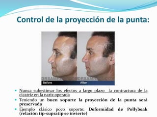 Control de la proyección de la punta:
 Nunca subestimar los efectos a largo plazo la contractura de la
cicatriz en la nariz operada
 Teniendo un buen soporte la proyección de la punta será
preservada
 Ejemplo clásico poco soporte: Deformidad de Pollybeak
(relación tip-supratip se invierte)
 