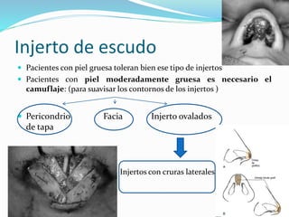 Injerto de escudo
 Pacientes con piel gruesa toleran bien ese tipo de injertos
 Pacientes con piel moderadamente gruesa es necesario el
camuflaje: (para suavisar los contornos de los injertos )
 Pericondrio Facia Injerto ovalados
de tapa
 Injertos con cruras laterales
 