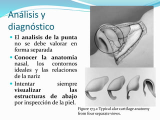Análisis y
diagnóstico
 El analisis de la punta
no se debe valorar en
forma separada
 Conocer la anatomia
nasal, los contornos
ideales y las relaciones
de la nariz
 Intentar siempre
visualizar las
estructuras de abajo
por inspección de la piel.
Figure 173.2 Typical alar cartilage anatomy
from four separate views.
 