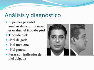 Análisis y diagnóstico
 El primer paso del
análisis de la punta nasal
es evaluar el tipo de piel
 Tipos de piel:
 -Piel delgada
 -Piel mediana
 -Piel gruesa
 Pecas son indicador de
piel delgada
 