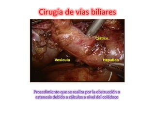 Cirugía de vías biliares Procedimiento que se realiza por la obstrucción o estenosis debido a cálculos a nivel del colédoco 