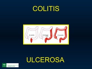 COLITIS ULCEROSA   
