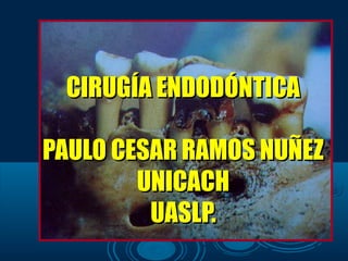 CIRUGÍA ENDODÓNTICA

PAULO CESAR RAMOS NUÑEZ
        UNICACH
         UASLP.
 