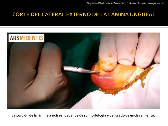 El preparado anónimo para el tratamiento del alcoholismo