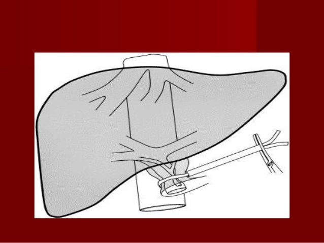 Cirugía hepática