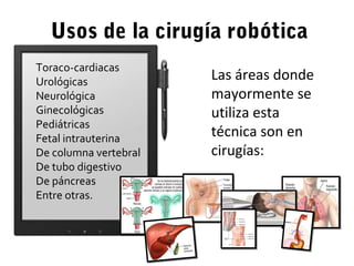 Usos de la cirugía robótica
Las áreas donde
mayormente se
utiliza esta
técnica son en
cirugías:
Toraco-cardiacas
Urológicas
Neurológica
Ginecológicas
Pediátricas
Fetal intrauterina
De columna vertebral
De tubo digestivo
De páncreas
Entre otras.
 
