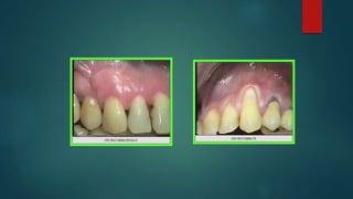 Cirugías Periodontales en Ortodoncia 2017.pptx