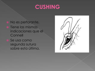 CUSHING





No es perforante,
Tiene las mismas
indicaciones que el
Connell
Se usa como
segunda sutura
sobre esta última.

 