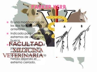 PARKER KERR
Es una modificación de
los dos tipos de sutura
anteriores
 Indicada para cerrar los
extremos de un órgano
hueco
 Al abrir y quitar está y al
jalar los extremos del
material de sutura, se
invierten los bordes de la
herida dejando el
extremo cerrado.


 