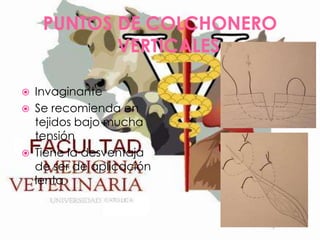 PUNTOS DE COLCHONERO
VERTICALES





Invaginante
Se recomienda en
tejidos bajo mucha
tensión
Tiene la desventaja
de ser de aplicación
lenta

 