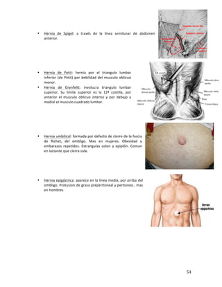 ! 54!
'
• Hernia' de' Spigel:' a' través' de' la' línea' semilunar' de' abdomen'
anterior.'
'
'
'
'
'
'
• Hernia' de' Petit:' hernia' por' el' triangulo' lumbar'
inferior'(de'Petit)'por'debilidad'del'musculo'oblicuo'
menor.''
• Hernia' de' Grynfeltt:' involucra' triangulo' lumbar'
superior.' Su' limite' superior' es' la' 12ª' costilla,' por'
anterior' el' musculo' oblicuo' interno' y' por' debajo' y'
medial'el'musculo'cuadrado'lumbar.''
'
'
'
'
'
'
• Hernia'umbilical:'formada'por'defecto'de'cierre'de'la'fascia'
de' Richet,' del' ombligo.' Mas' en' mujeres.' Obesidad' y'
embarazos' repetidos.' Estrangulas' colon' y' epiplón.' Comun'
en'lactante'que'cierra'sola.'
'
'
'
'
'
• Hernia'epigástrica:'aparece'en'la'línea'media,'por'arriba'del'
ombligo.'Protusion'de'grasa'preperitoneal'y'peritoneo..'mas'
en'hombres'
'
'
'
'
'
'
'
'
'
'
'
'
'
'
 