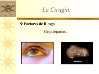 La Cirugía.
 Factores de Riesgo
Hepatopatías.
 