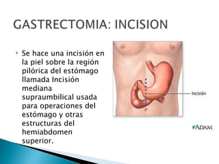    Se hace una incisión en
    la piel sobre la región
    pilórica del estómago
    llamada Incisión
    mediana
    supraumbilical usada
    para operaciones del
    estómago y otras
    estructuras del
    hemiabdomen
    superior.
 