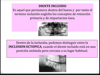 Cirugia dientes-incluidos 2 | PDF