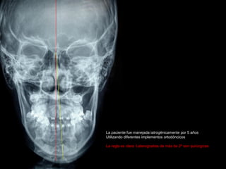La paciente fue manejada iatrogénicamente por 5 años
Utilizando diferentes implementos ortodóncicos
La regla es clara: Laterognatias de más de 2º son quirúrgicas
 