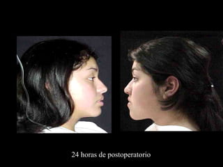 24 horas de postoperatorio
 