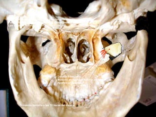Cóndilo fracturado
Músculo pterigoideo externo contracturado
Apófisis ptrigoides
El desplazamiento condilar y su proceso inflamatorio,
Pueden hacer compresión sobre los elementos que atraviesan
Los agujeros redondo mayor, menor y rasgado.
Intrusión dentaria a las 72 horas del trauma
 