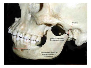 Fractura
Impacción de muñón
En cavida glenoidea
Pseudoclase II
Contractura traumática de
Músculo masetero y
Pterigoideos
 