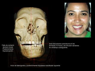 Area decontactos prematuros en las
Primeras 72 horas y de intrusión dentarias
En el tiempo subsiguiente.
Falta de contacto
dentario inicial.
Posteriormente
Supraerupción.
Inicio de laterognatia y posteriormente hipoplasia mandibular izquierda
 