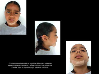 El trauma mentoniano es un signo de alerta para pediatras
Odontopediatras, dentistas y sobre todo para los padres de
Familia, pues la sintomatología inicial es casi nula.
 