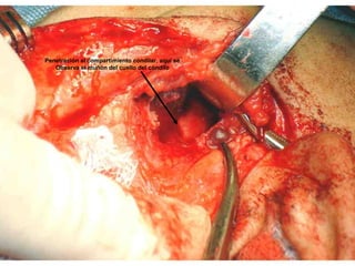 Penetración al compartimiento condilar, aquí se
Observa el muñón del cuello del cóndilo
 