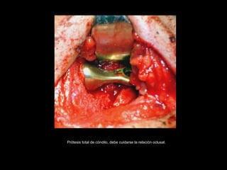 Prótesis total de cóndilo, debe cuidarse la relación oclusal.
 