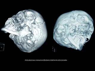 Articulaciones craneomandibulares totalmente afuncionales
 