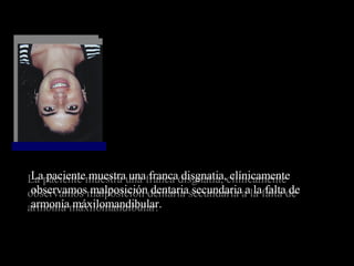 La paciente muestra una franca disgnatia, clínicamente
observamos malposición dentaria secundaria a la falta de
armonía máxilomandibular.
La paciente muestra una franca disgnatia, clínicamente
observamos malposición dentaria secundaria a la falta de
armonía máxilomandibular.
 
