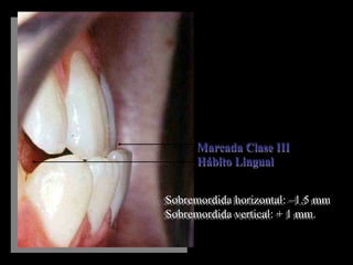 Marcada Clase III
Hábito Lingual
Marcada Clase III
Hábito Lingual
Sobremordida horizontal: –1.5 mm
Sobremordida vertical: + 1 mm.
Sobremordida horizontal: –1.5 mm
Sobremordida vertical: + 1 mm.
 
