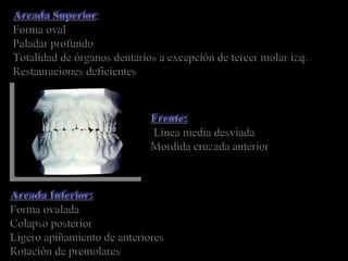 Arcada Superior:
Forma oval
Paladar profundo
Totalidad de órganos dentarios a excepción de tercer molar izq.
Restauraciones deficientes
Arcada Superior:
Forma oval
Paladar profundo
Totalidad de órganos dentarios a excepción de tercer molar izq.
Restauraciones deficientes
Frente:
Línea media desviada
Mordida cruzada anterior
Frente:
Línea media desviada
Mordida cruzada anterior
Arcada Inferior:
Forma ovalada
Colapso posterior
Ligero apiñamiento de anteriores
Rotación de premolares
Arcada Inferior:
Forma ovalada
Colapso posterior
Ligero apiñamiento de anteriores
Rotación de premolares
 