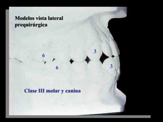 Modelos vista lateral
prequirúrgica
Modelos vista lateral
prequirúrgica
6
6
3
3
Clase III molar y caninaClase III molar y canina
 