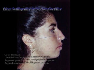 Línea Perfilográfica del Dr. González UlloaLínea Perfilográfica del Dr. González Ulloa
Cifras promedio:
Línea de Frankfurt a glabela-mentón 90 grados
Angulo de punto N a línea nasal promedio 30 grados
Angulo Labio-Nasal 90 a 110 grados promedio
Cifras promedio:
Línea de Frankfurt a glabela-mentón 90 grados
Angulo de punto N a línea nasal promedio 30 grados
Angulo Labio-Nasal 90 a 110 grados promedio
 
