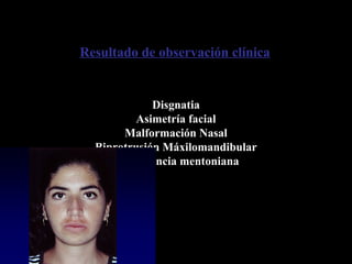 Disgnatia
Asimetría facial
Malformación Nasal
Biprotrusión Máxilomandibular
Insuficiencia mentoniana
Resultado de observación clínica
 
