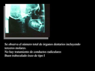 Se observa el número total de órganos dentarios incluyendo
terceros molares.
No hay tratamiento de conductos radiculares
Buen trabeculado óseo de tipo I
Se observa el número total de órganos dentarios incluyendo
terceros molares.
No hay tratamiento de conductos radiculares
Buen trabeculado óseo de tipo I
 