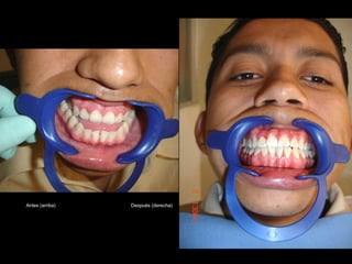 Antes (arriba) Después (derecha)
 