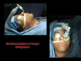 Morbimortalidad en Cirugía
Ortognática
Morbimortalidad en Cirugía
Ortognática
 