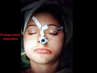 Postoperatorio
Inmediato
 