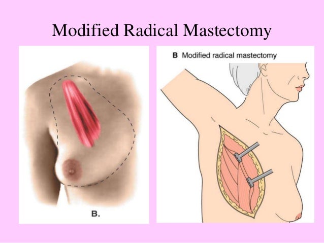 mastectomy dating sites Are you wondering how to begin dating with or after cancer how to navigate dating with cancer share pin email search the site go more in cancer living with. mastectomy dating sites Are you wondering how to begin dating with or after cancer how to navigate dating with cancer share pin email search the site go more in cancer living with.