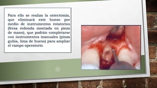 Para ello se realiza la ostectomía,
que eliminará este hueso por
medio de instrumentos rotatorios
(fresa redonda montada en pieza
de mano), que podrán completarse
con instrumentos manuales (pinza
gubia, lima de hueso) para ampliar
el campo operatorio.
 