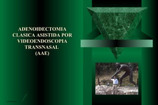 ADENOIDECTOMIA
CLASICA ASISTIDA POR
 VIDEOENDOSCOPIA
    TRANSNASAL
       (AAE)
 