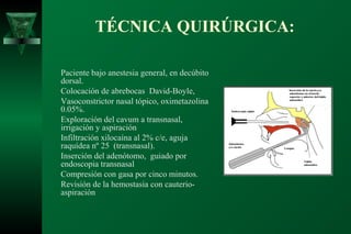 TÉCNICA QUIRÚRGICA:

Paciente bajo anestesia general, en decúbito
dorsal.
Colocación de abrebocas David-Boyle,
Vasoconstrictor nasal tópico, oximetazolina
0.05%.
Exploración del cavum a transnasal,
irrigación y aspiración
Infiltración xilocaína al 2% c/e, aguja
raquídea nº 25 (transnasal).
Inserción del adenótomo, guiado por
endoscopia transnasal
Compresión con gasa por cinco minutos.
Revisión de la hemostasia con cauterio-
aspiración
 