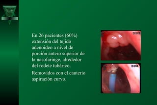 En 26 pacientes (60%)
extensión del tejido
adenoideo a nivel de
porción antero superior de
la nasofaringe, alrededor
del rodete tubárico.
Removidos con el cauterio
aspiración curvo.
 