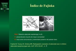 Índice de Fujioka




     •RAN: Relación adenoide nasofaringe (>o,8)
     •A: perpendicular al punto de mayor convexidad
     •N: trazo entre sincondrosis y extremidad posterior del paladar óseo.


Fujioka M, Young LW, Girdany BR. Radiographic evaluation of adenoidal size in children:
adenoidal-nasopharyngeal ratio. AJR 1979;133:401 - 4. 0
 