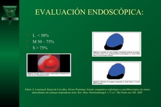 EVALUACIÓN ENDOSCÓPICA:

 •     L < 50%
 •     M 50 – 75%
 •     S > 75%




Edmir A. LourençoI; Karen de Carvalho; Álvaro Pontriana. Estudo comparativo radiológico e nasofibroscópico do olume
      adenoideano em crianças respiradoras orais. Rev. Bras. Otorrinolaringol. v.71 n.1 São Paulo ene./feb. 2005
 