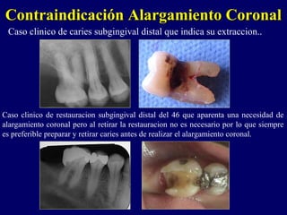 Contraindicación Alargamiento CoronalContraindicación Alargamiento Coronal
Caso clinico de caries subgingival distal que indica su extraccion..
Caso clinico de restauracion subgingival distal del 46 que aparenta una necesidad de
alargamiento coronal pero al retirar la restauracion no es necesario por lo que siempre
es preferible preparar y retirar caries antes de realizar el alargamiento coronal.
 