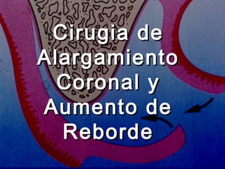 Cirugia deCirugia de
AlargamientoAlargamiento
Coronal yCoronal y
Aumento deAumento de
RebordeReborde
 