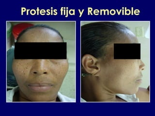 Protesis fija y Removible
 