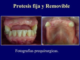 Protesis fija y Removible
Fotografias prequirurgicas.
 